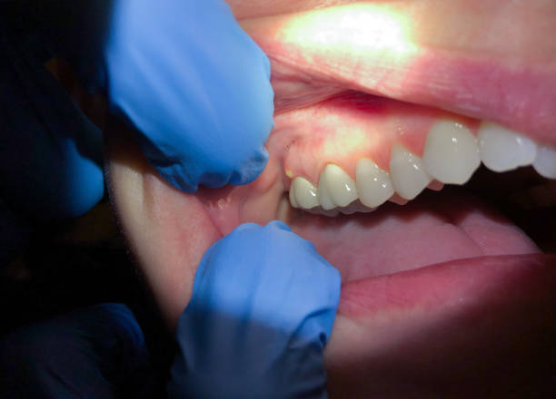 Best Emergency Treatment for Toothache in Washington, IA