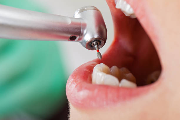Best Emergency Root Canal Treatment in Washington, IA
